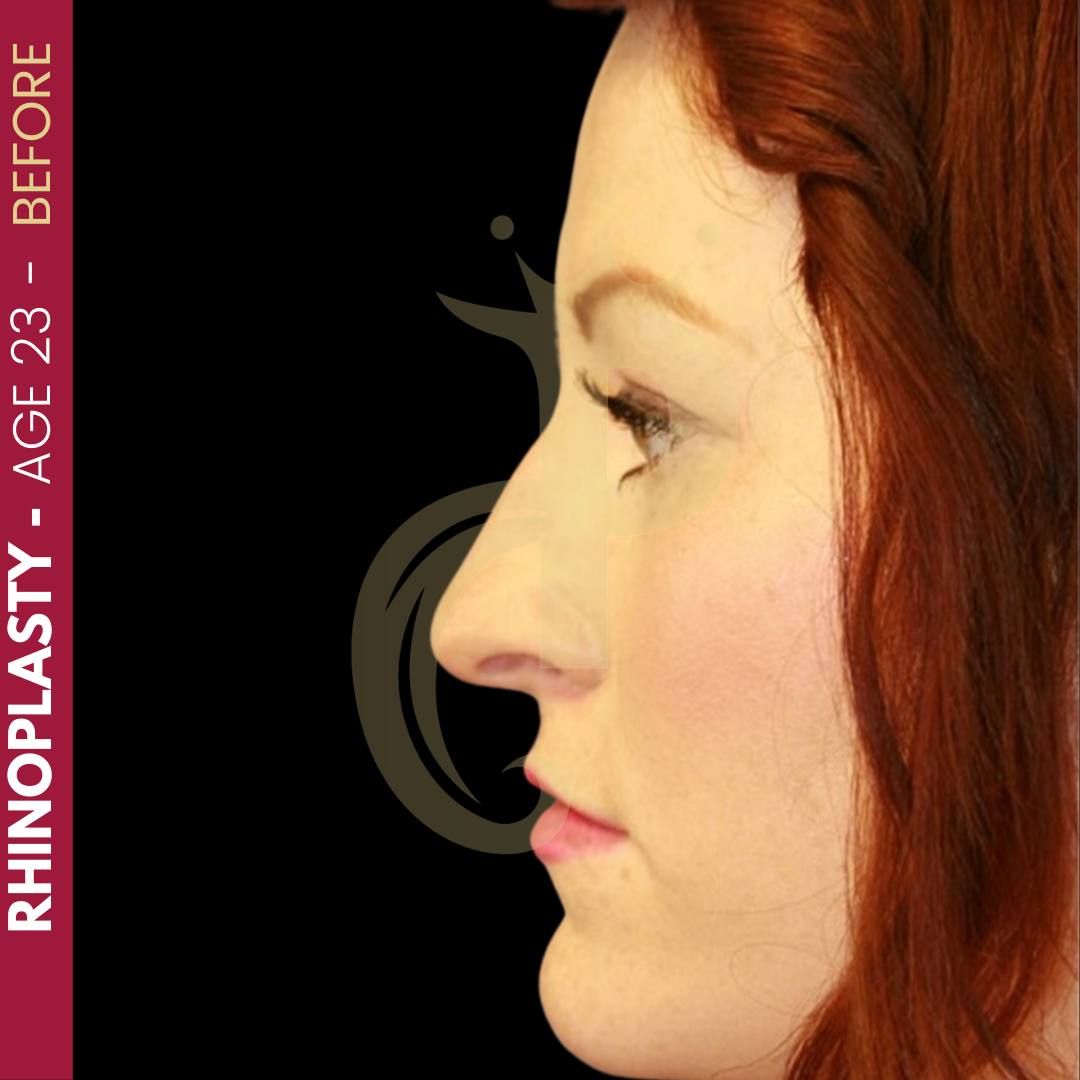 Gastric Bypass Pixl Clinic Leader Aesthetic, Hair Transplant, Bariatric Surgery, Cosmetic