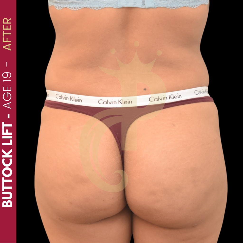 Body Fat Transfer Before After