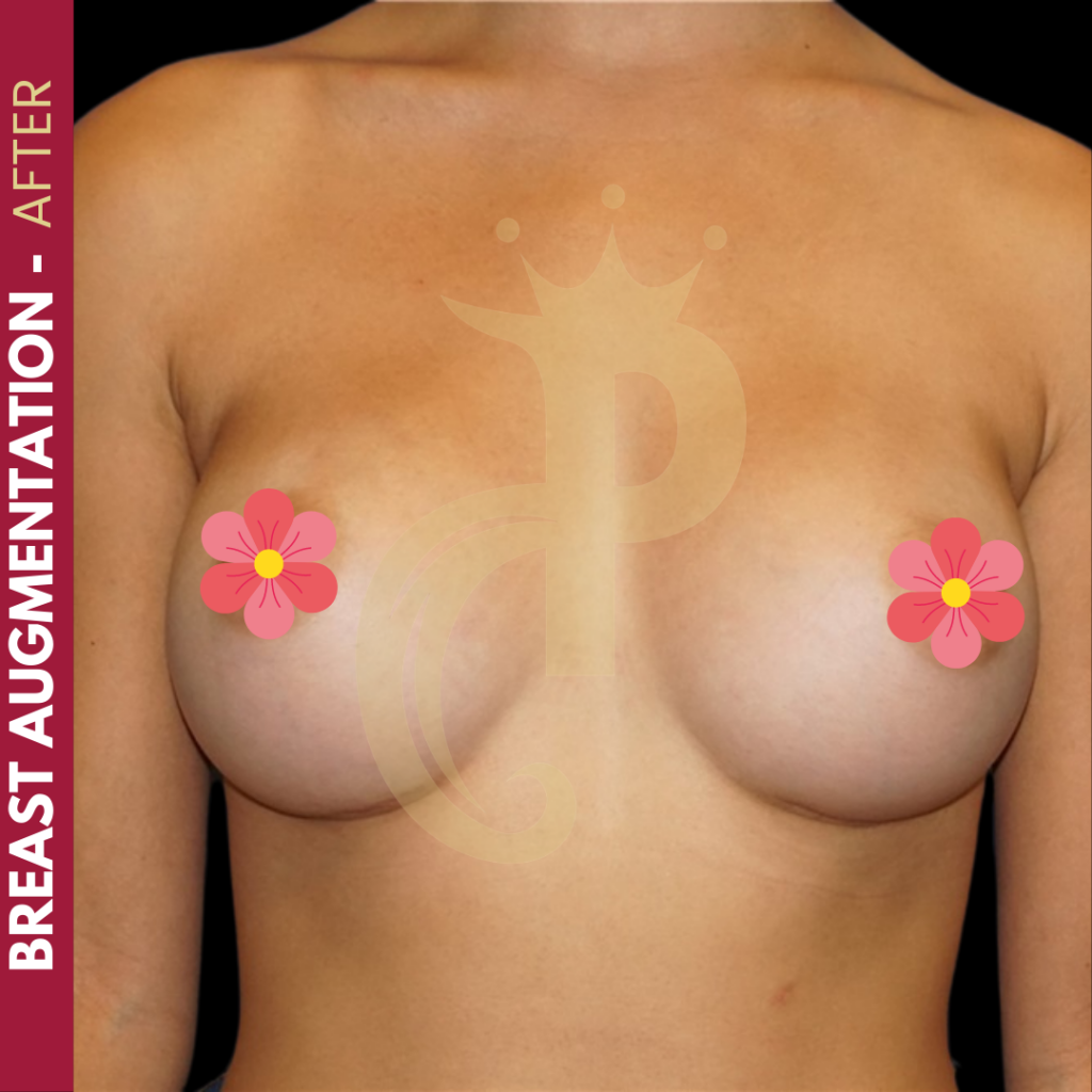 Breast augmentation before and after