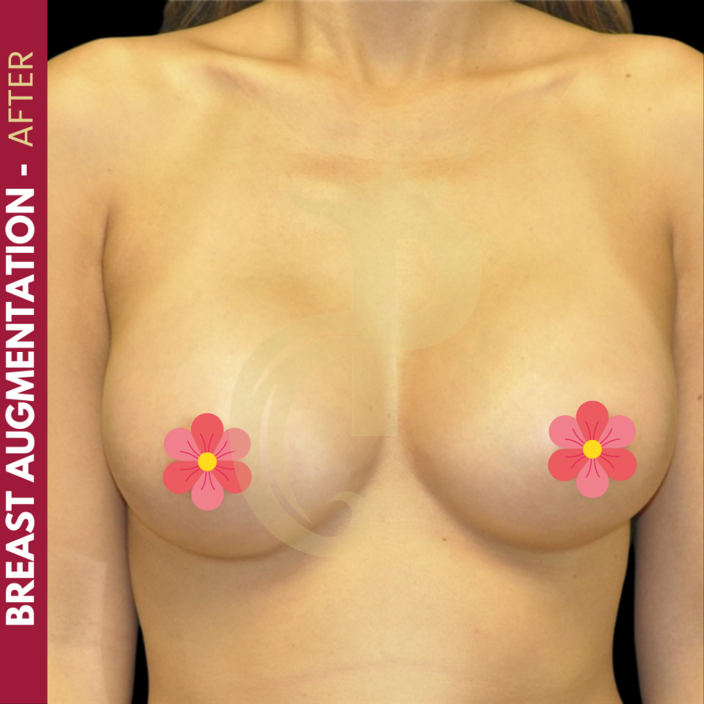 Breast augmentation before and after