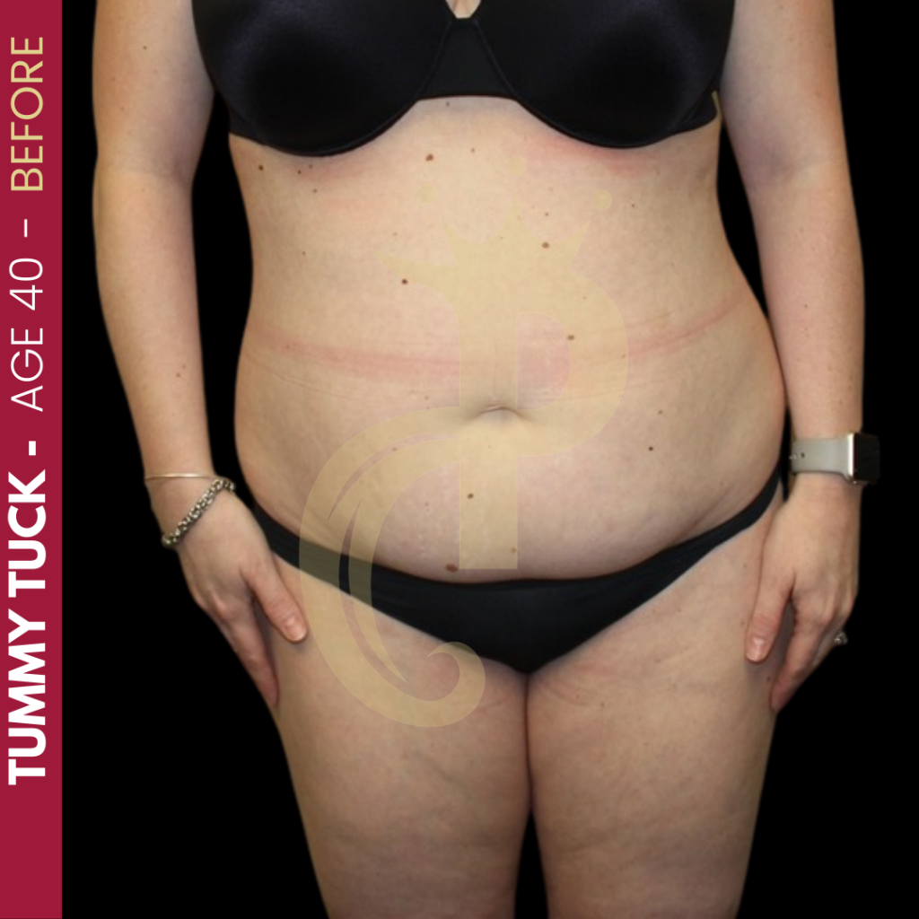 Tummy Tuck Before After