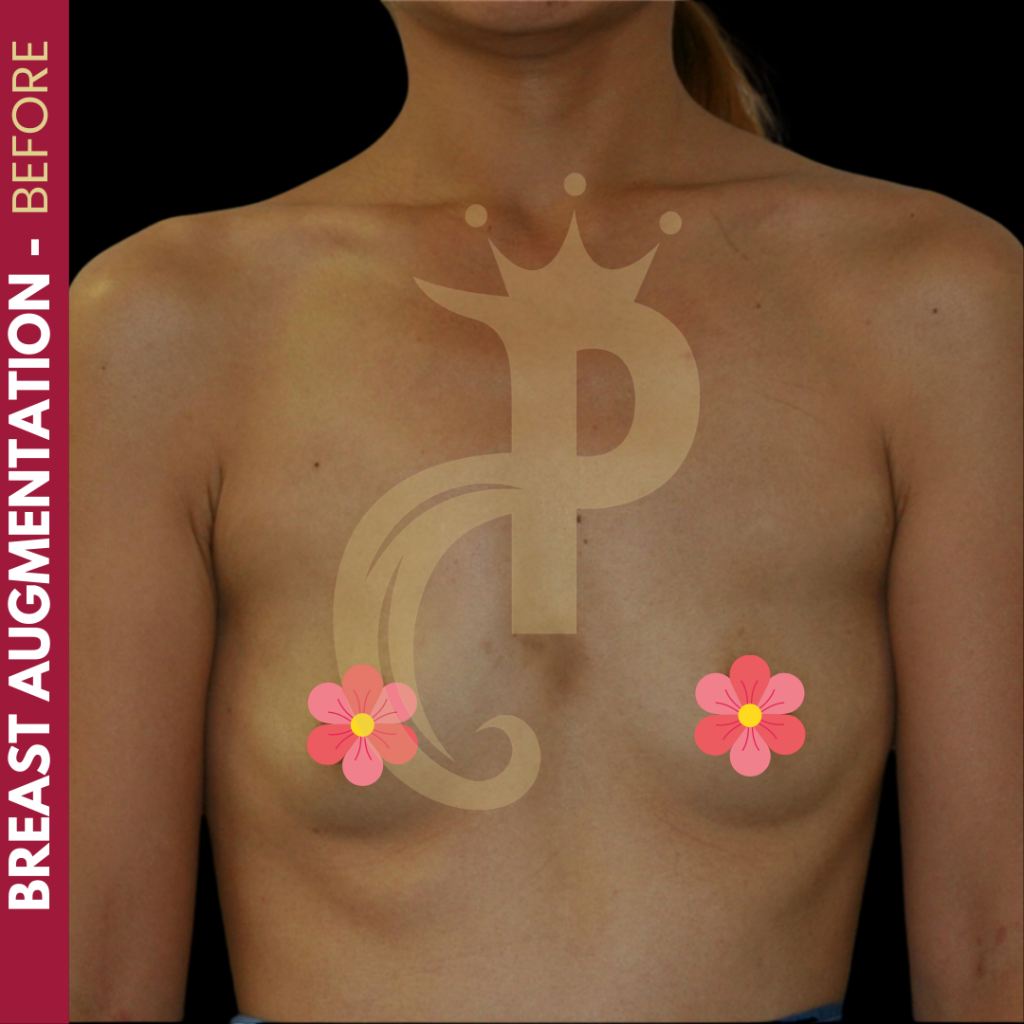 Breast augmentation before and after