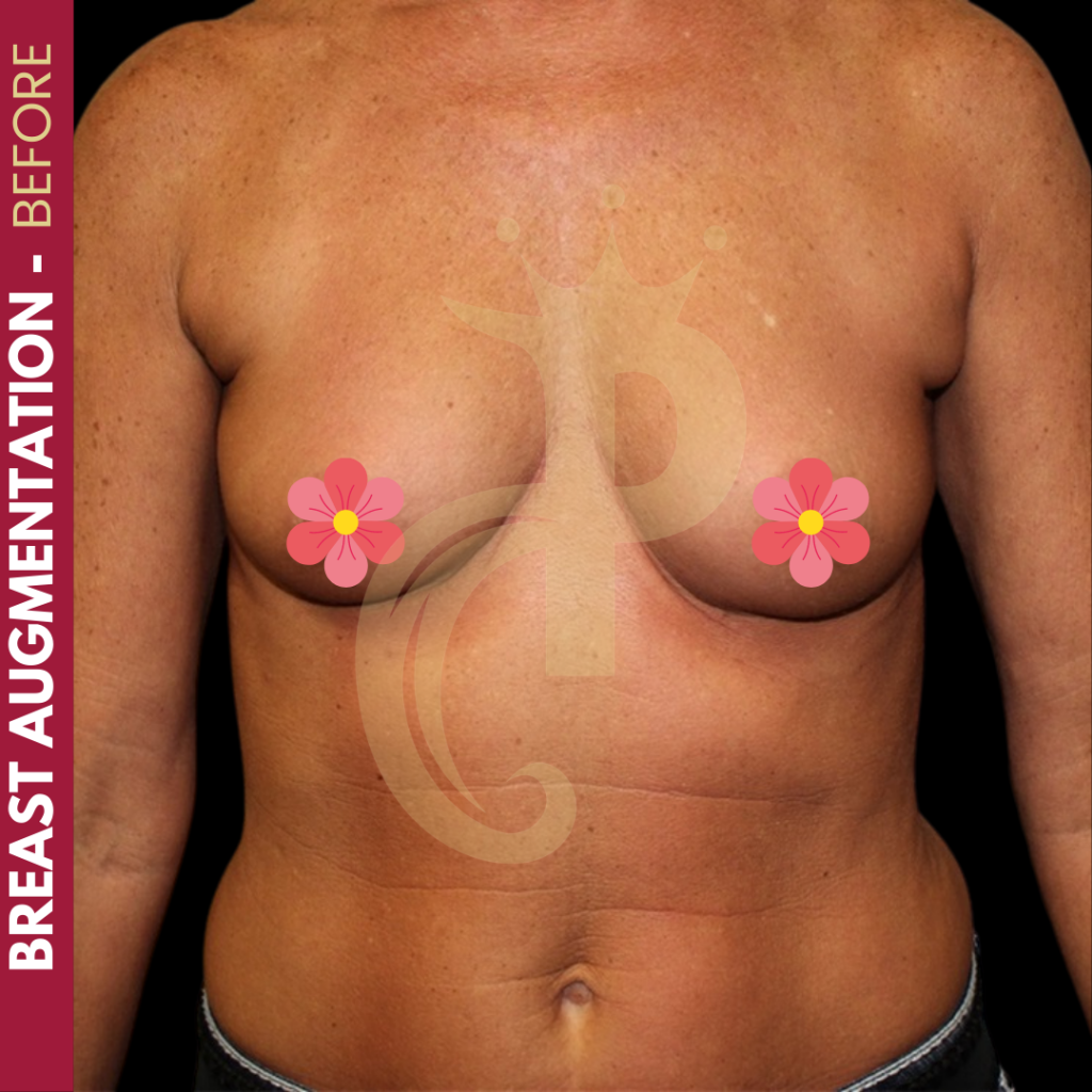 Breast augmentation before and after