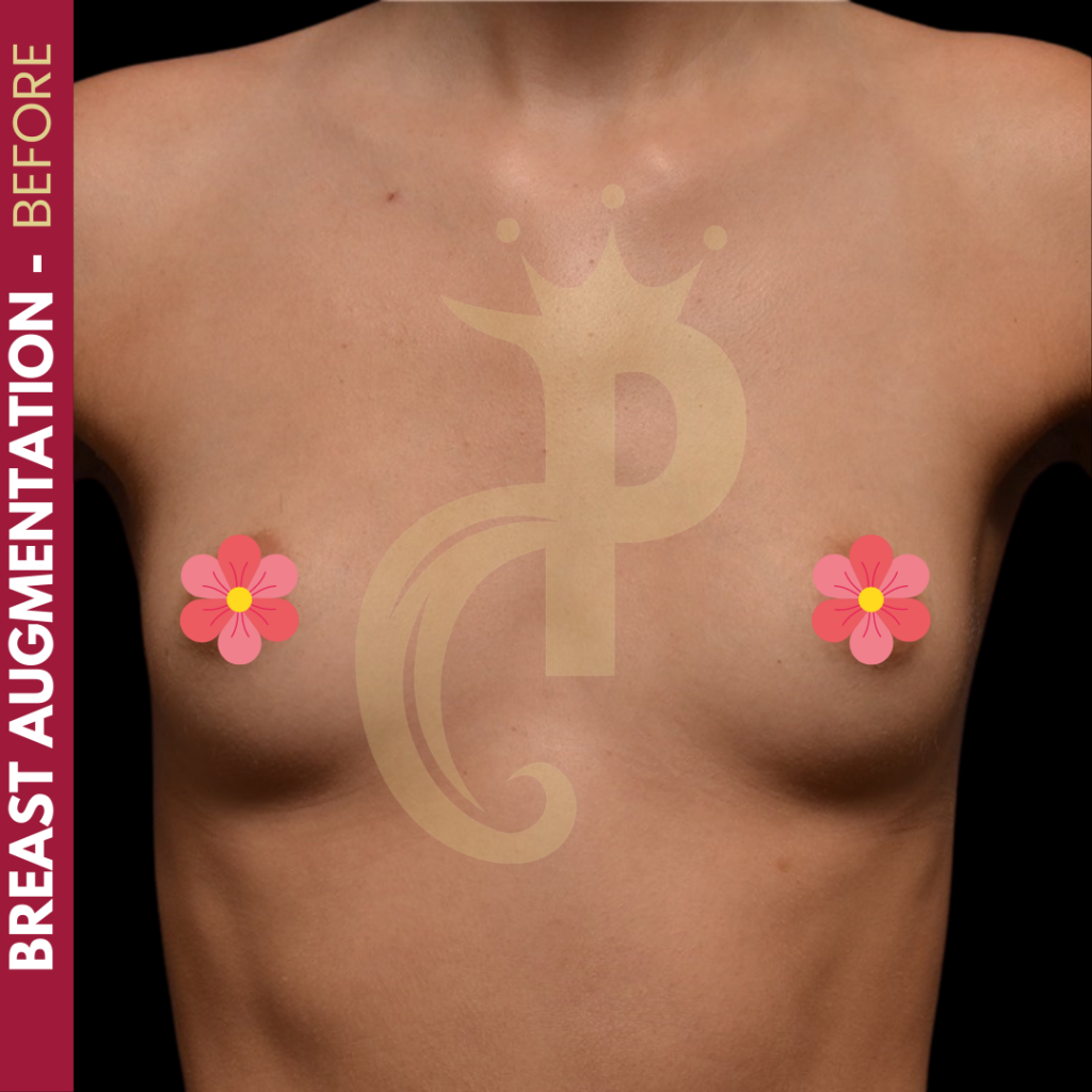 Breast augmentation before and after