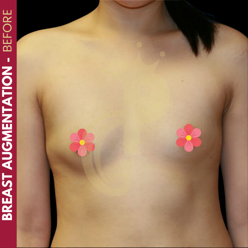 Breast augmentation before and after