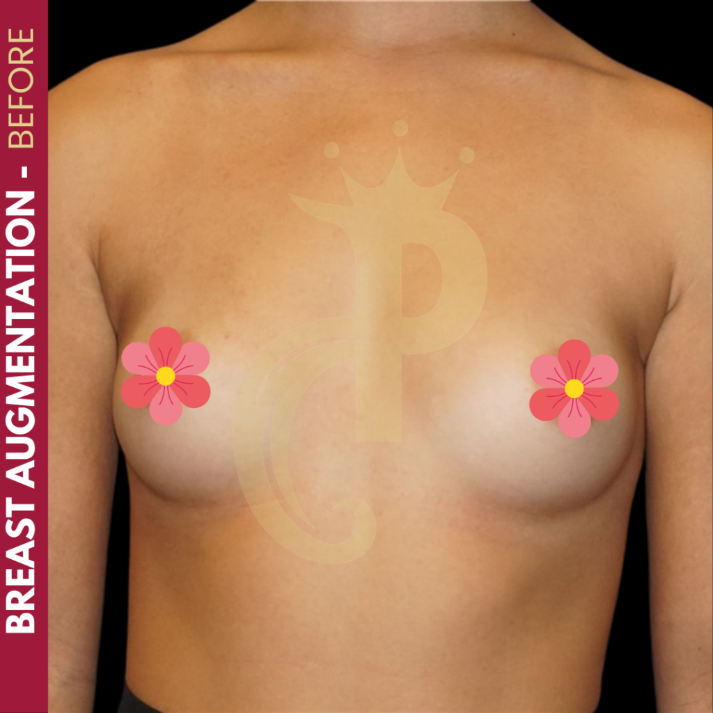 Breast augmentation before and after