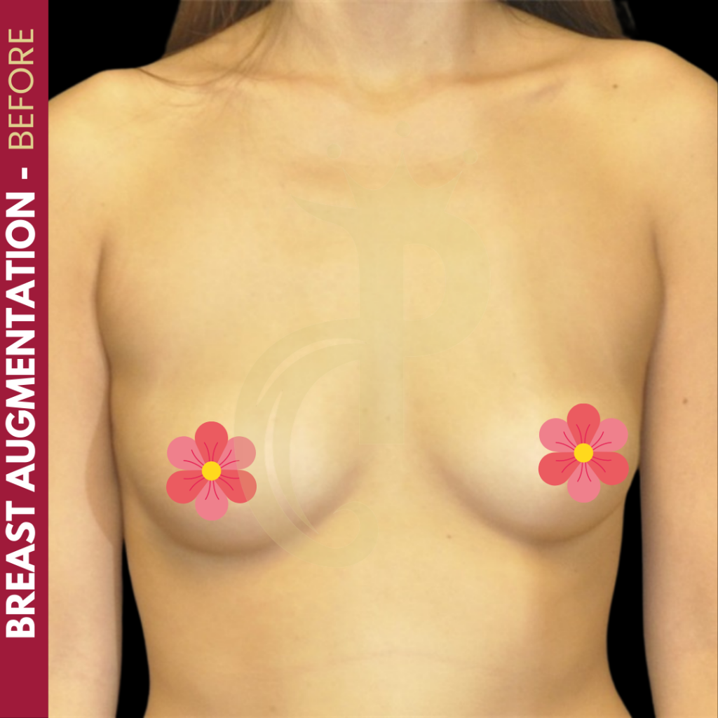 Breast augmentation before and after