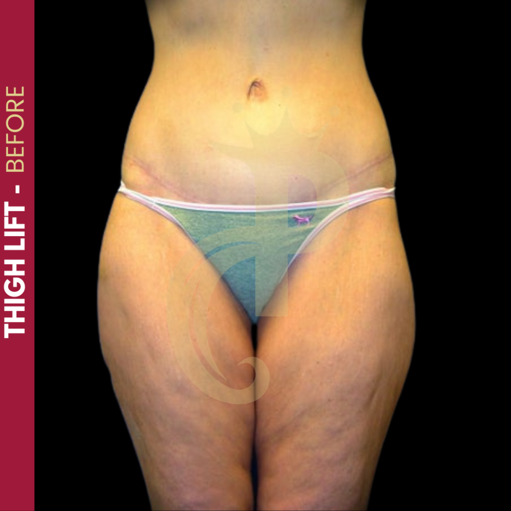 Thigh Lift Before and After
