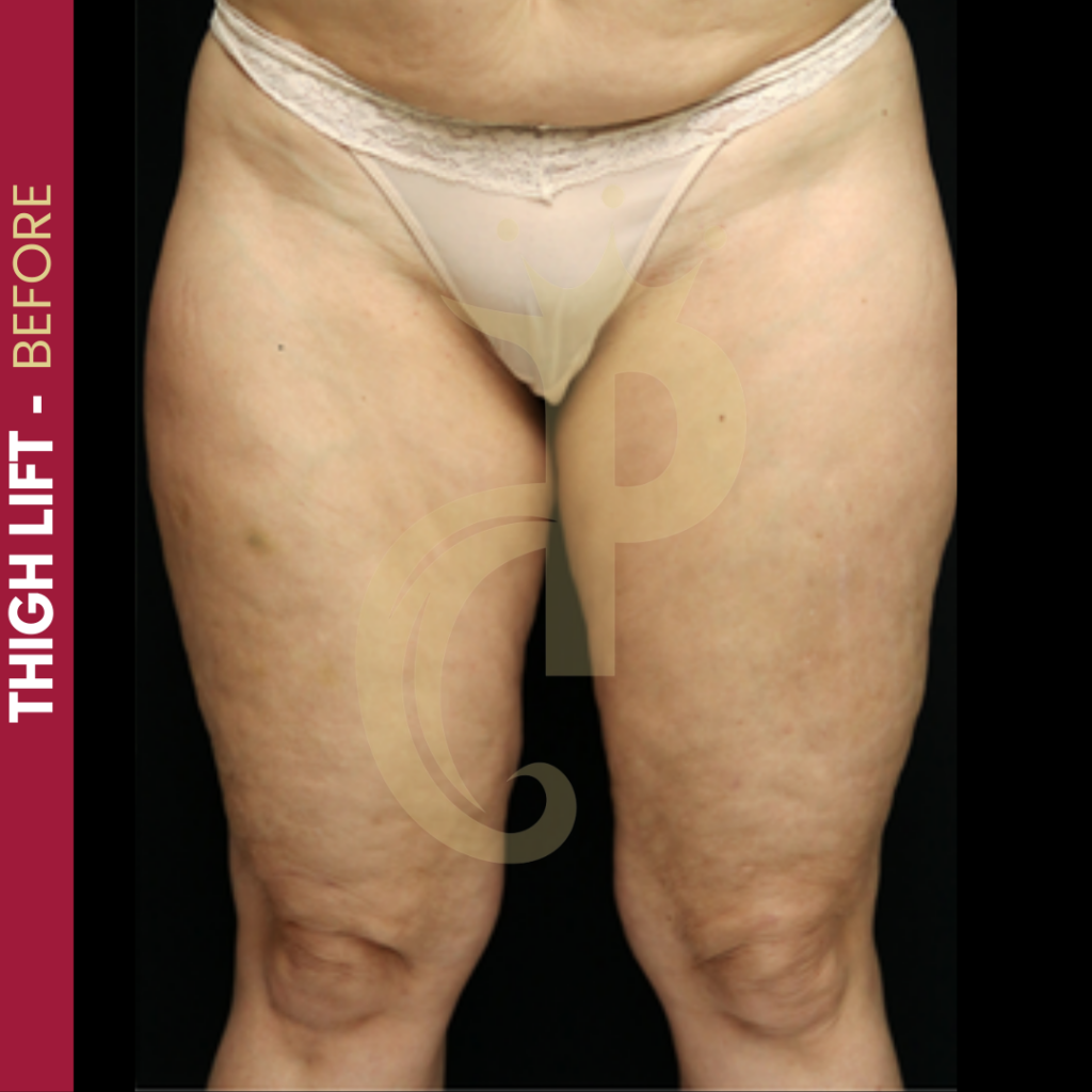 Thigh Lift Before and After