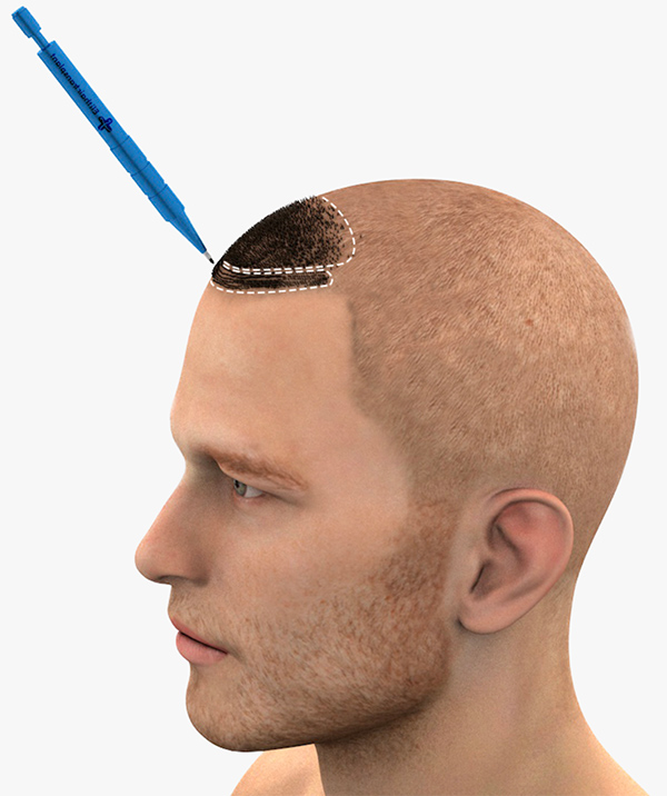 A graphic explaining the Sapphire hair transplant method