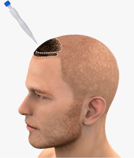 A man with a shave head and an explanation of the DHI hair transplant on the frontal area