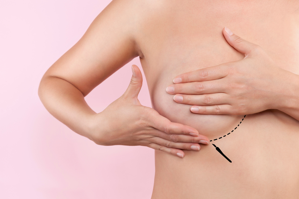 Breast Augmentation6