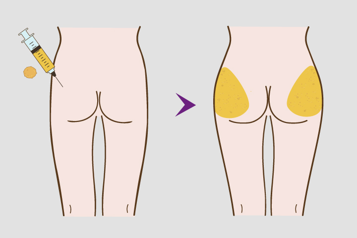 Buttock Augmentation 