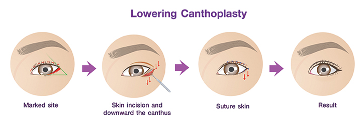 Canthoplasty