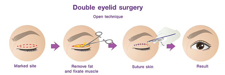 Double eyelid surgery