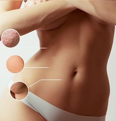 Liposuction Istanbul, Steps & Cost Advantages! - Global Clinic