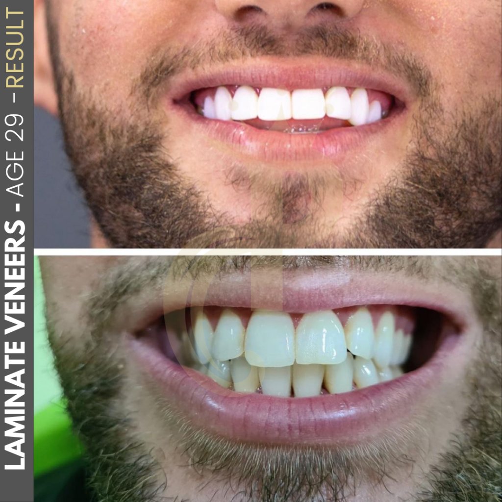 Hollywood Smile Before and After