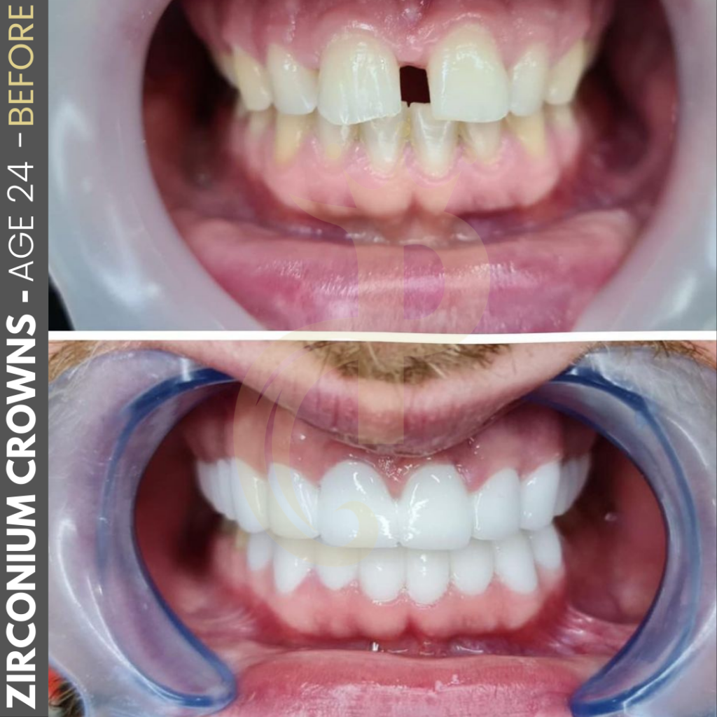 Hollywood Smile Before and After