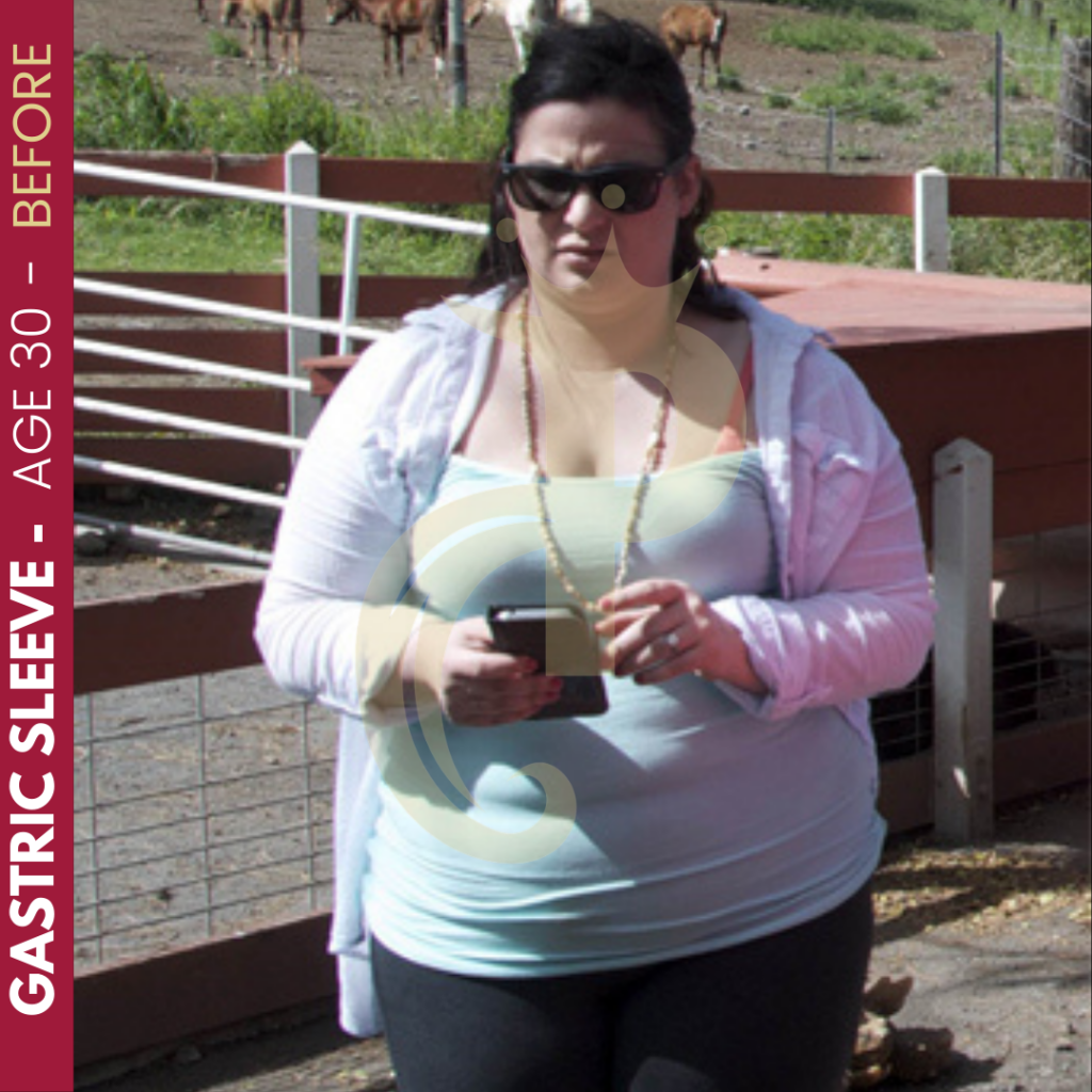 Gastric Sleeve Before and After