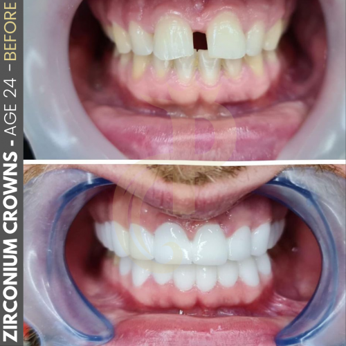 Zirconia Crown in Turkey Cost, Procedure, Best Clinic Pixl Clinic