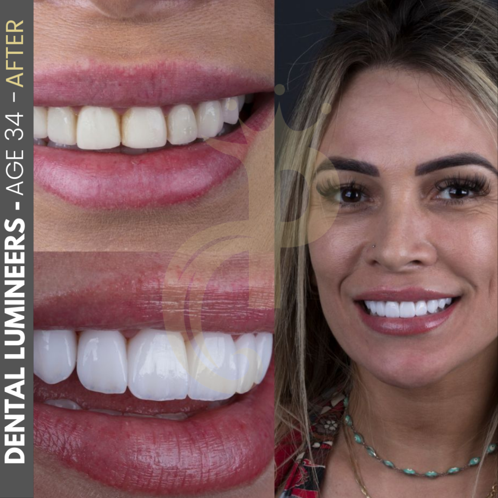 Hollywood Smile Before and After