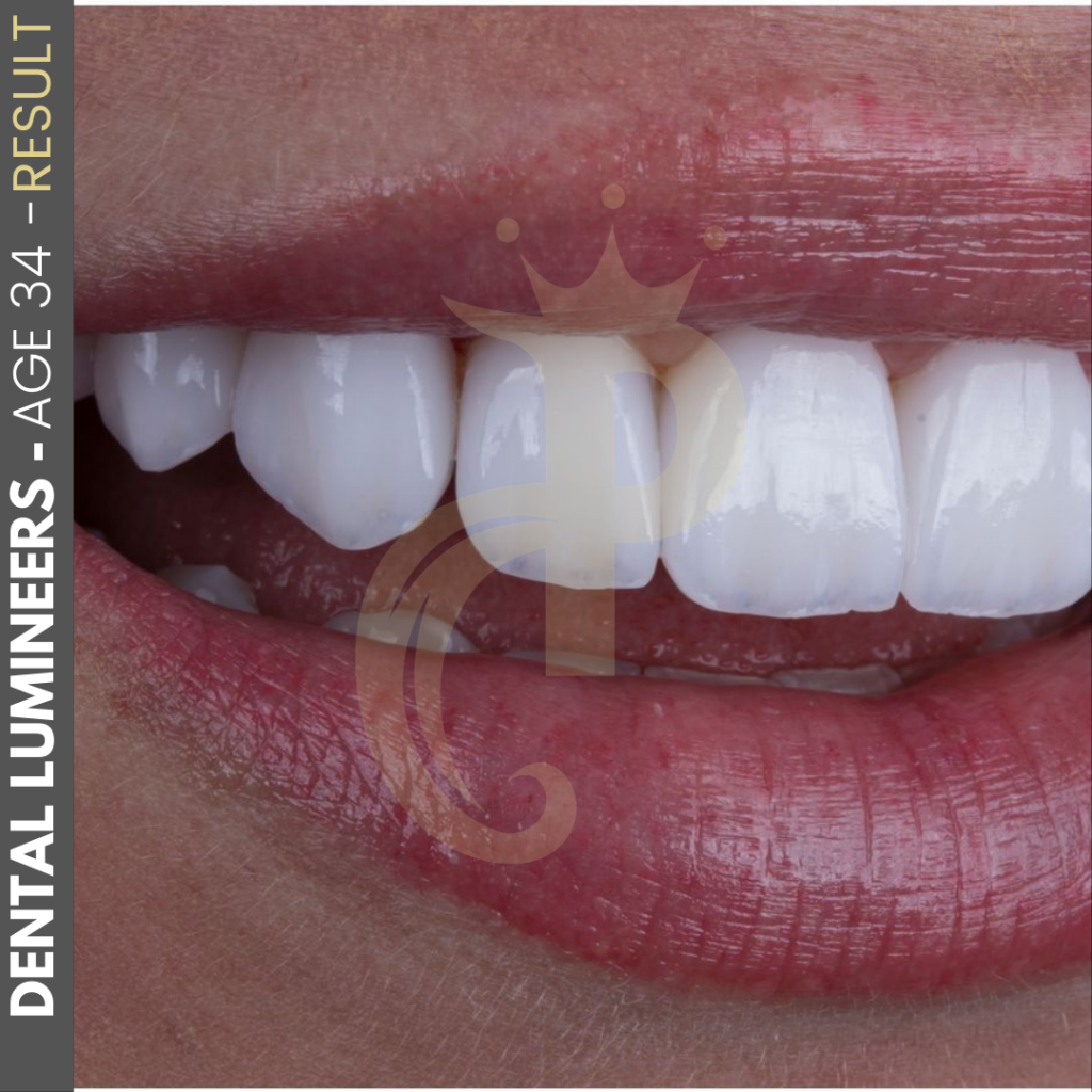 Hollywood Smile Before and After