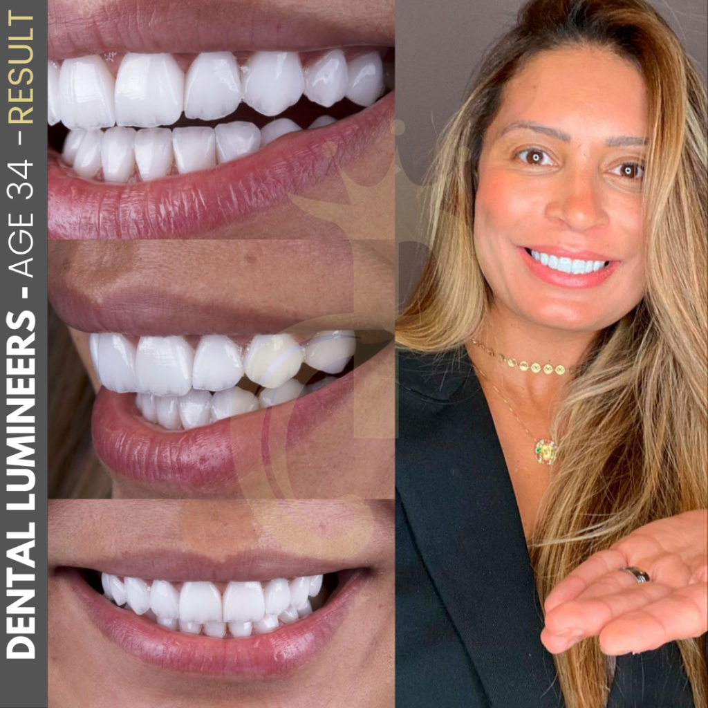 Hollywood Smile Before and After