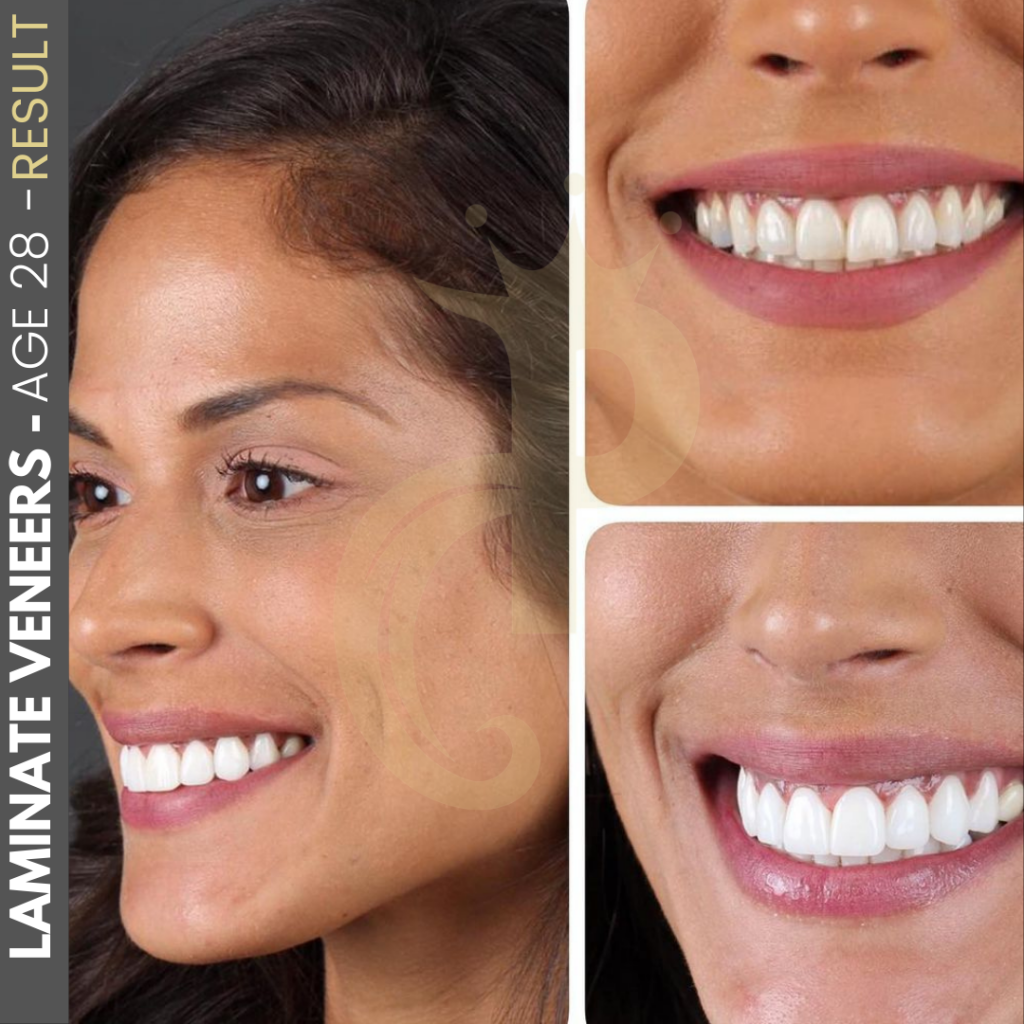 Hollywood Smile Before and After
