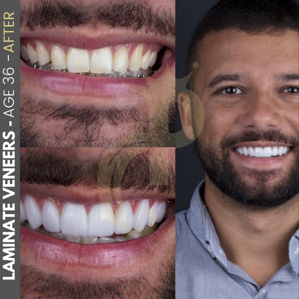 Hollywood Smile Before and After