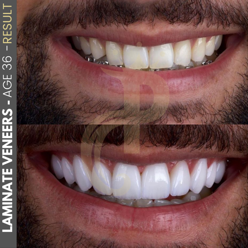 Hollywood Smile Before and After