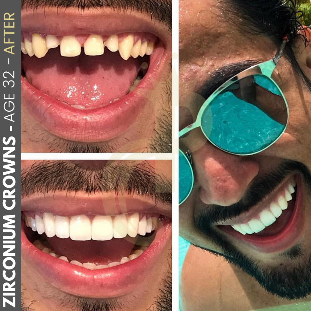 Hollywood Smile Before and After