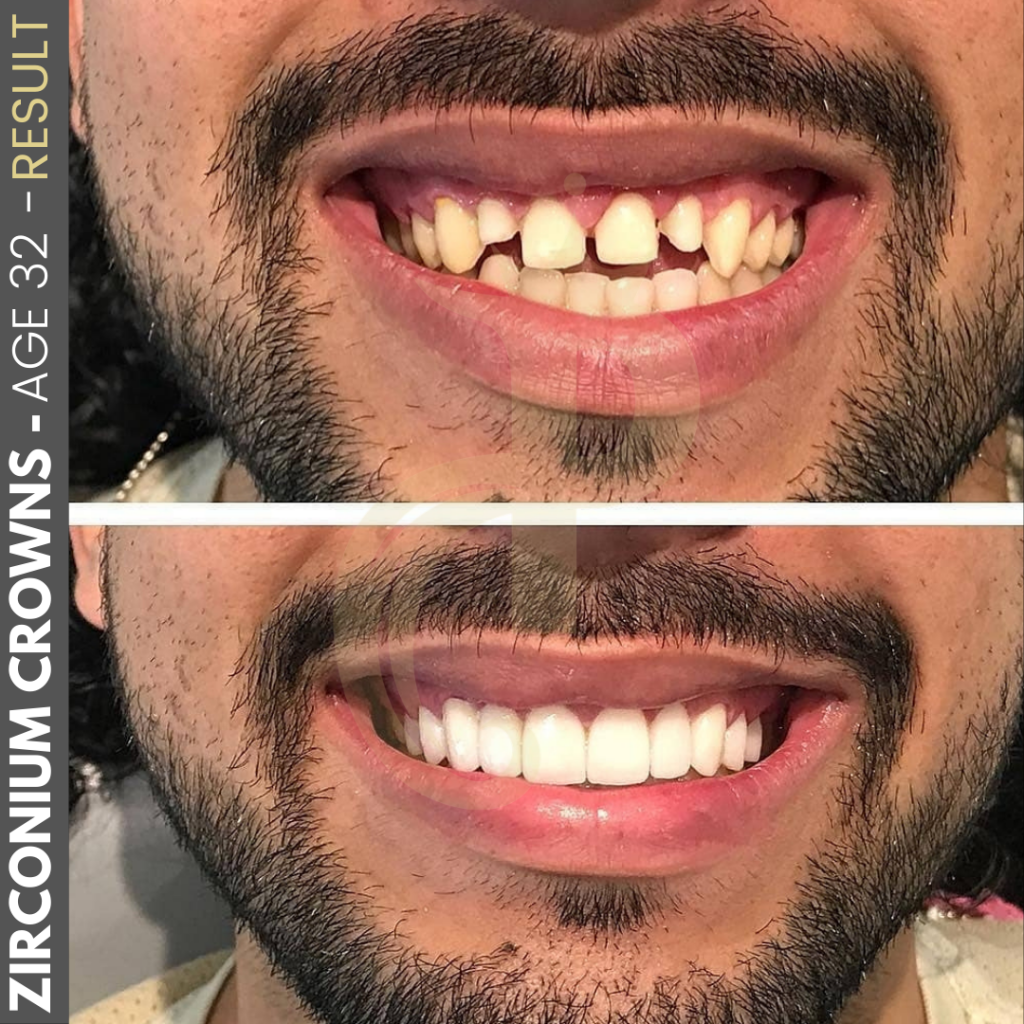 Hollywood Smile Before and After