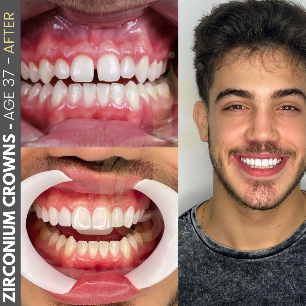 Hollywood Smile Before and After