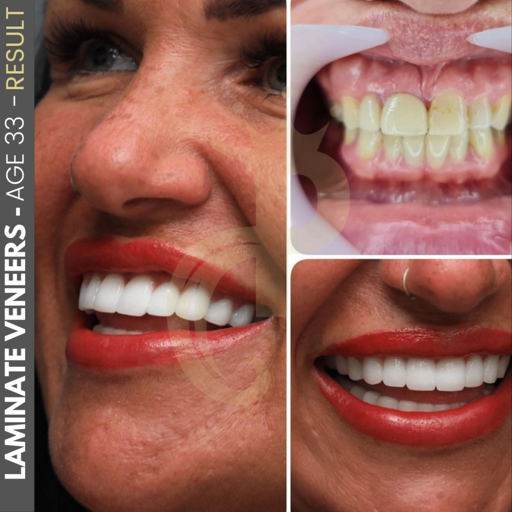 Hollywood Smile Before and After