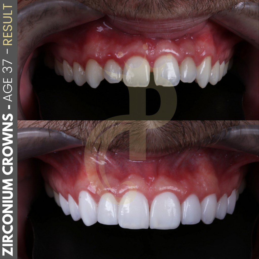 Hollywood Smile Before and After