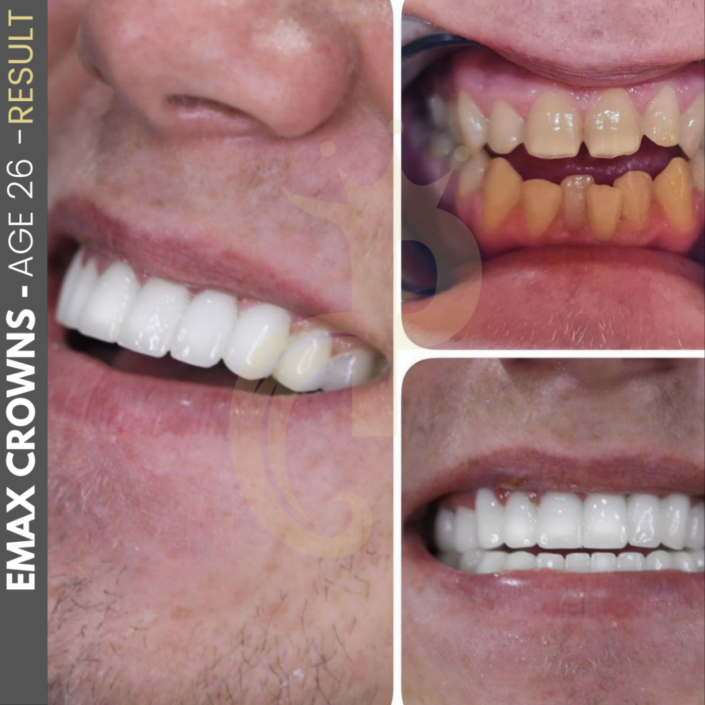 Hollywood Smile Before and After