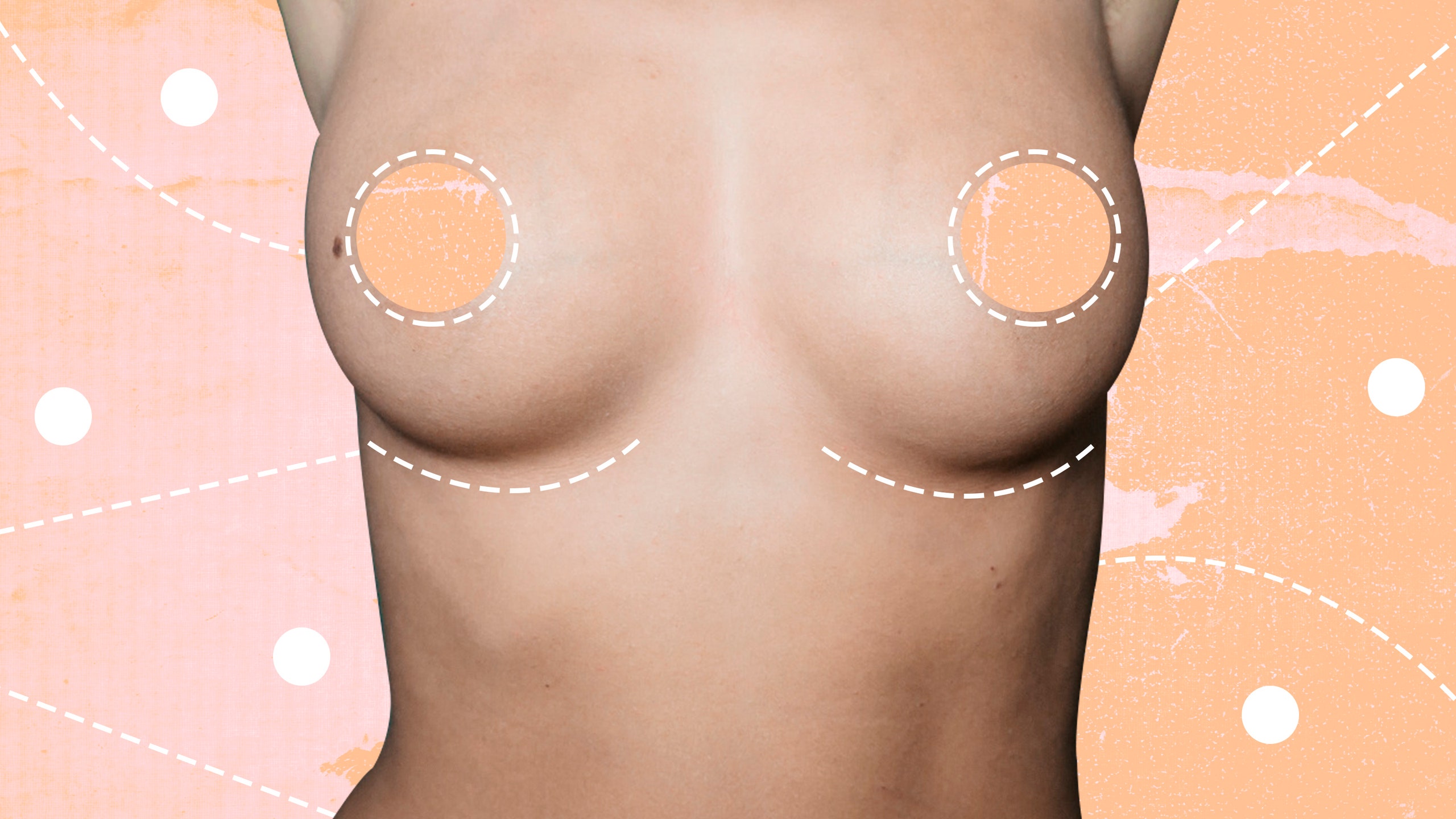 Breast Augmentation1