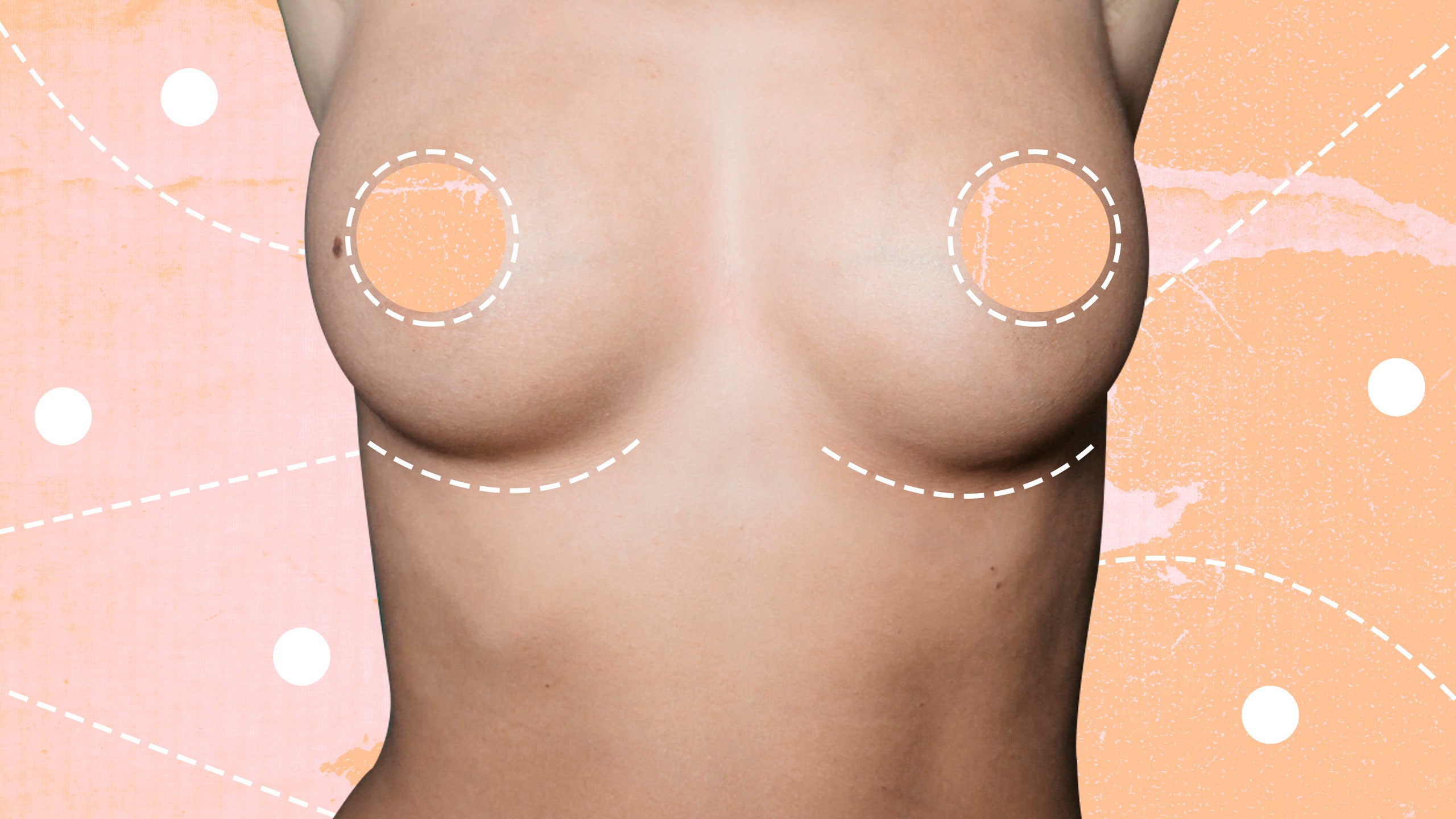 Breast Fat Transfer