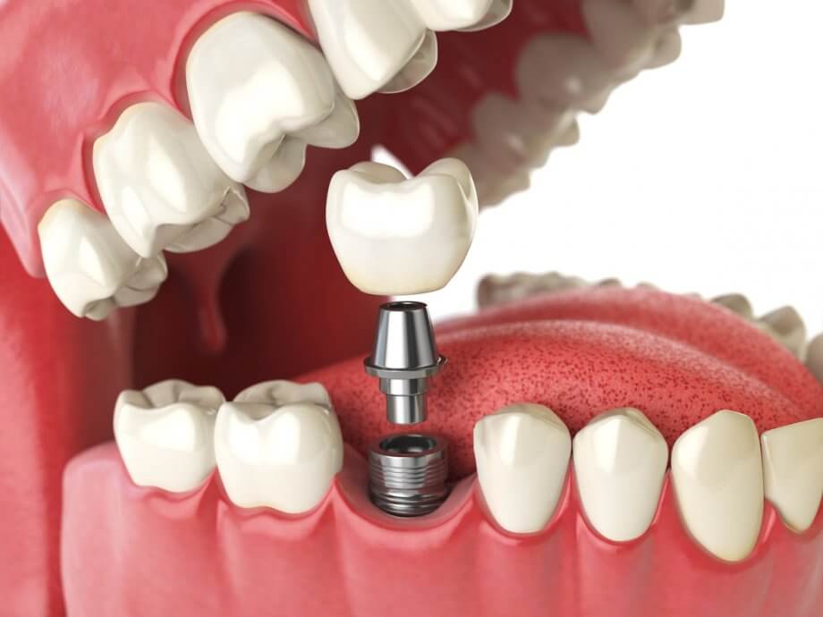Dental Implant Closeup 920x690 1