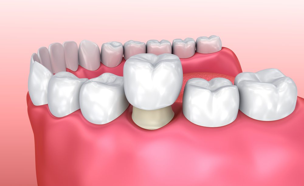 dental crown process 1