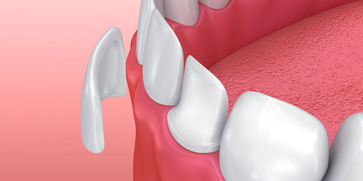 Quelle est la différence entre facette dentaire et couronne porcelaine ?