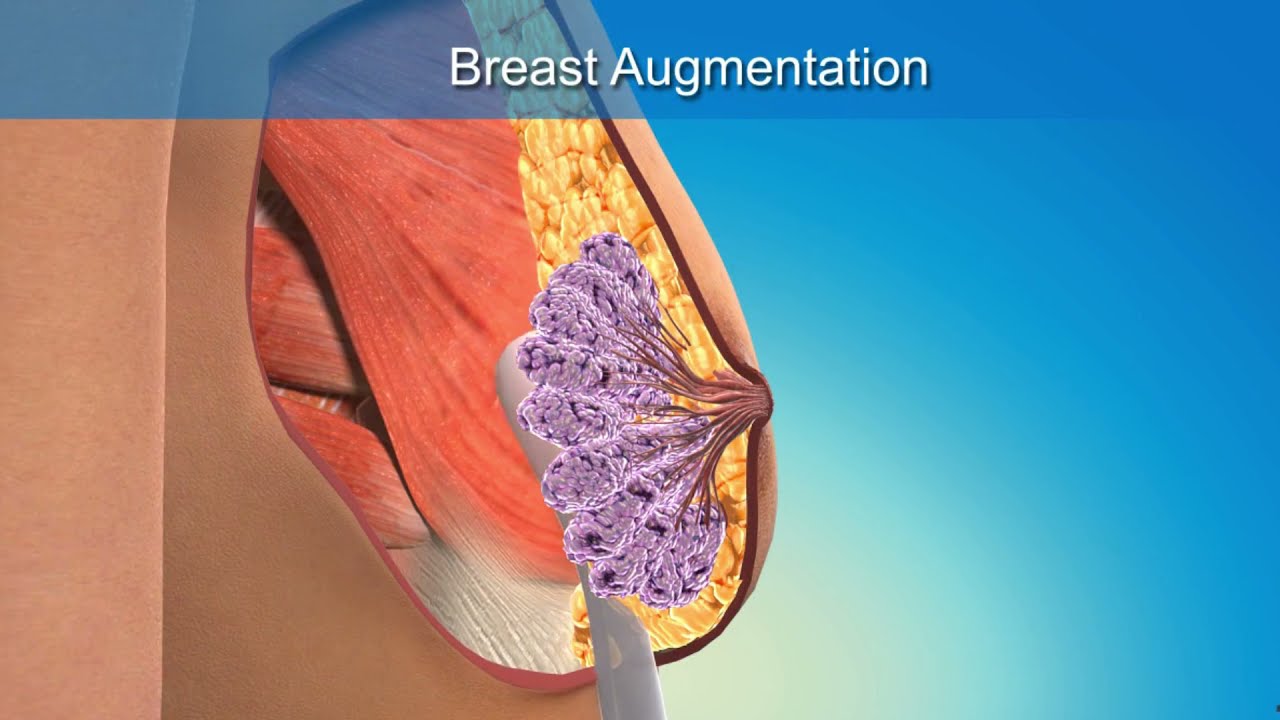 Breast Reconstruction in Turkey | Cost, Procedure, Best Clinic | Pixl Clinic