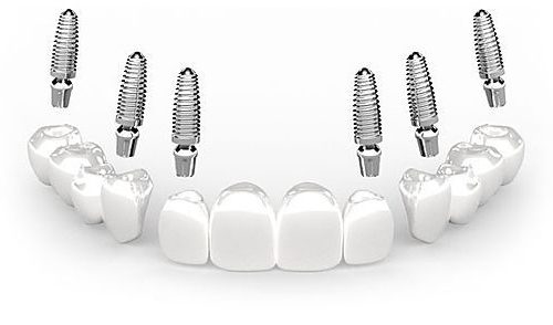 3-on-6-Dental-Implants-turkey.