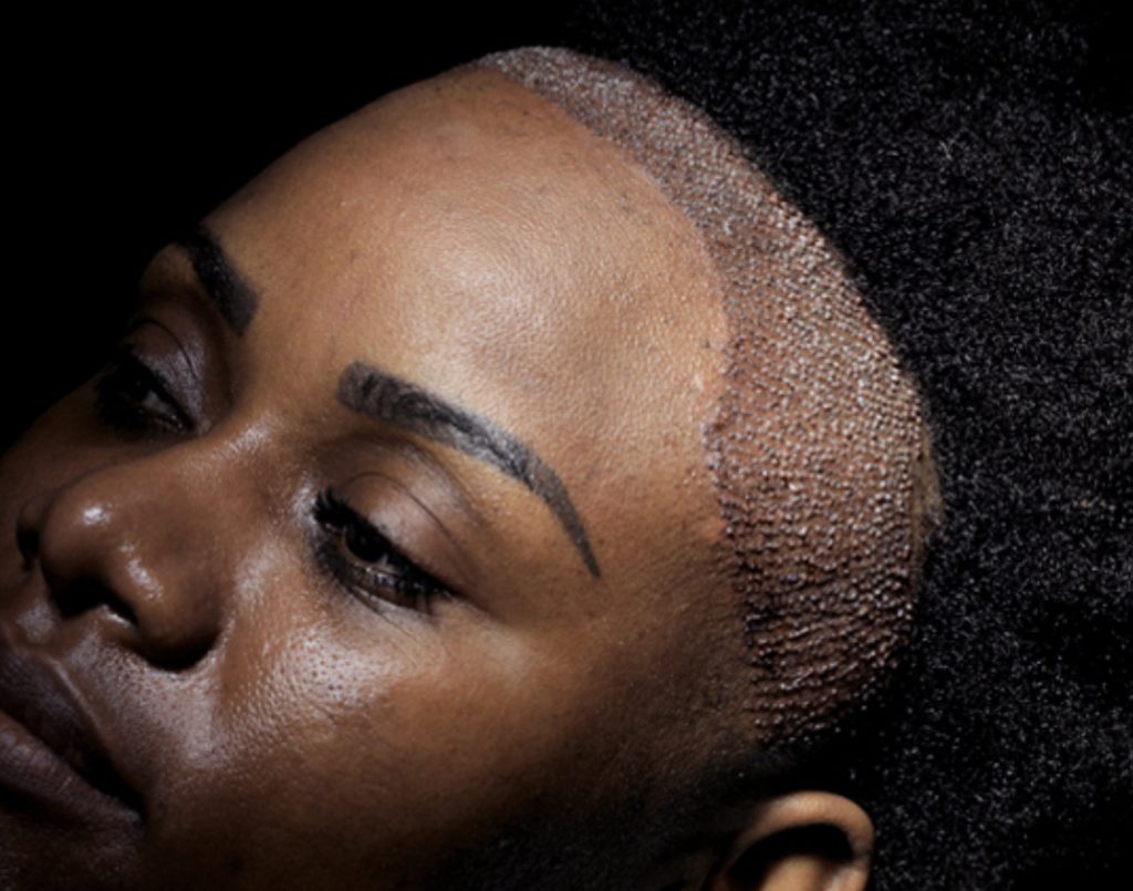 Afro haartransplantatie in Turkije 1 Afro haartransplantatie in Turkije