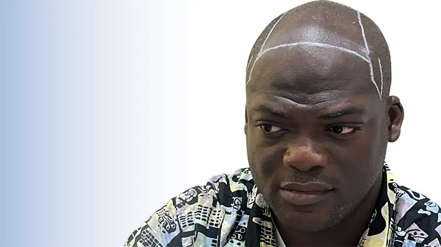 Afro Hair Transplant in Turkey 1 Afro-hair-transplant-in-Turkey