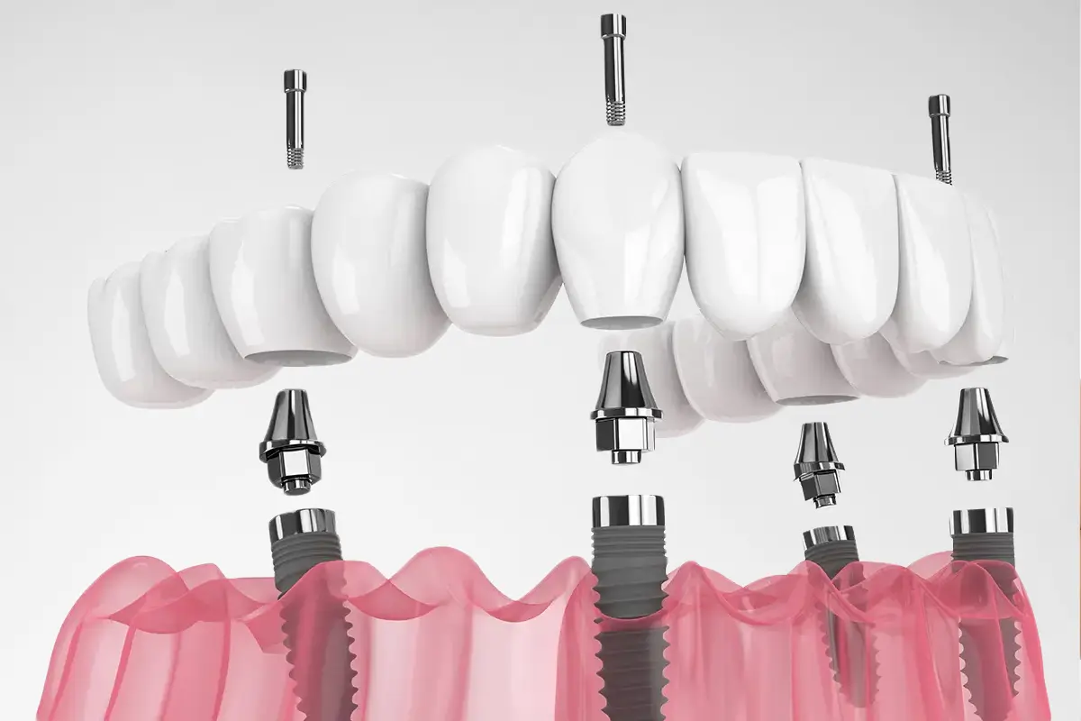 All On 4 implantaten in Turkije 1 All On 4 implantaten in Turkije