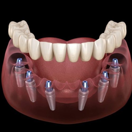 All-On-6 implantaten in Turkije