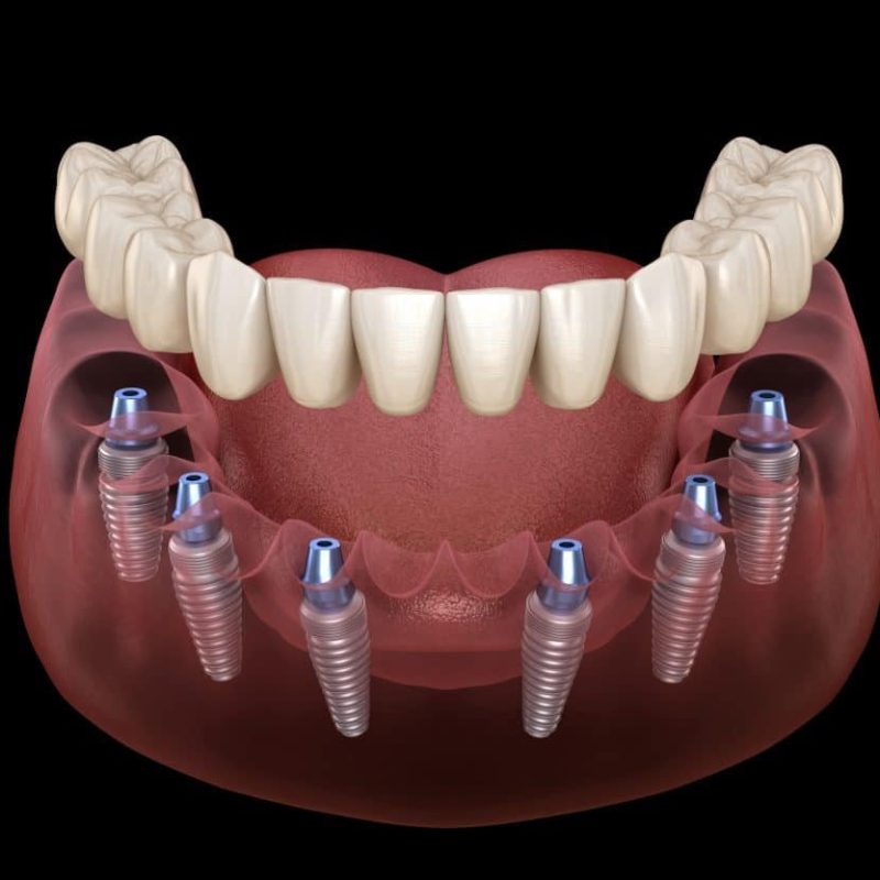All-On-6 implantaten in Turkije 1 All-On-6 implantaten in Turkije
