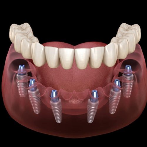 All-On-Six-Implants-turkey.