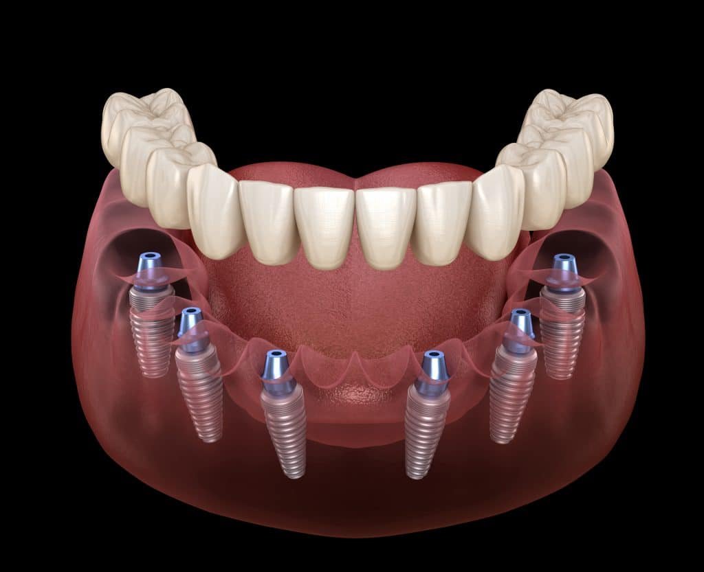All On Six Implants Turkey 1 All-On-Six-Implants-turkey.